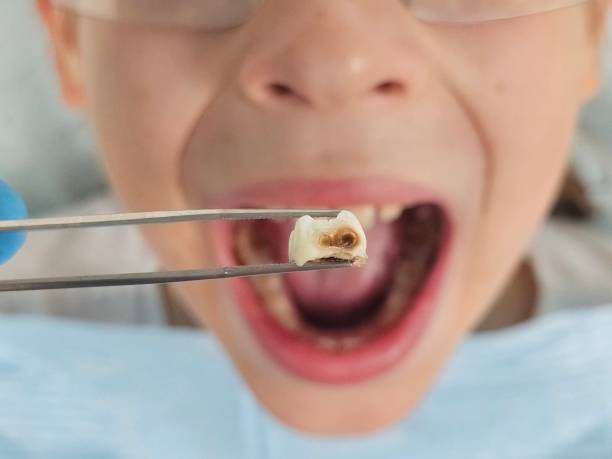 Best Emergency Tooth Extraction in Piney Point Village, TX